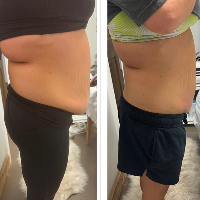 Fat Treatment Bundle (6 sessions) at Luxe Body in Newnan, GA